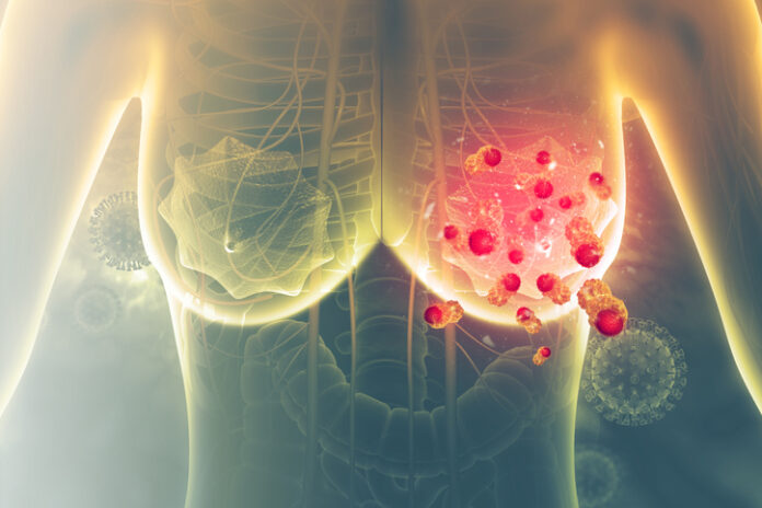 Especialista alerta aumento del cáncer de mama en mujeres jóvenes